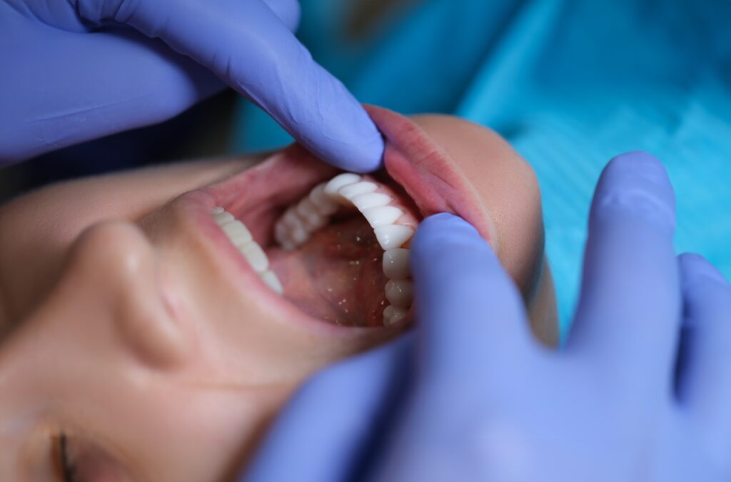 Can Veneers Look Natura