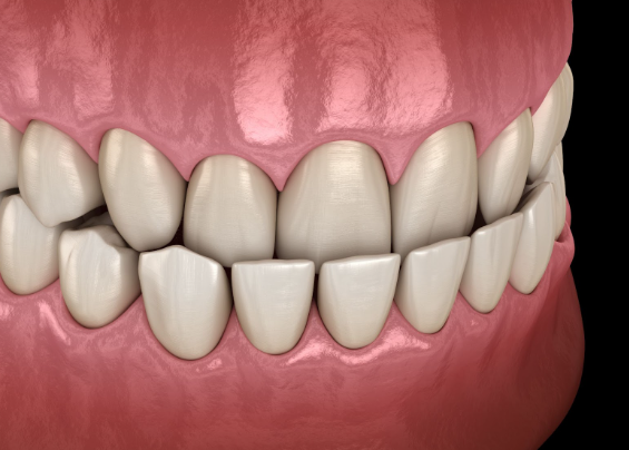 can veneers fix underbite