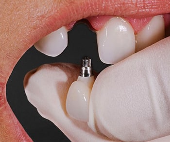 what are the dental implants made of