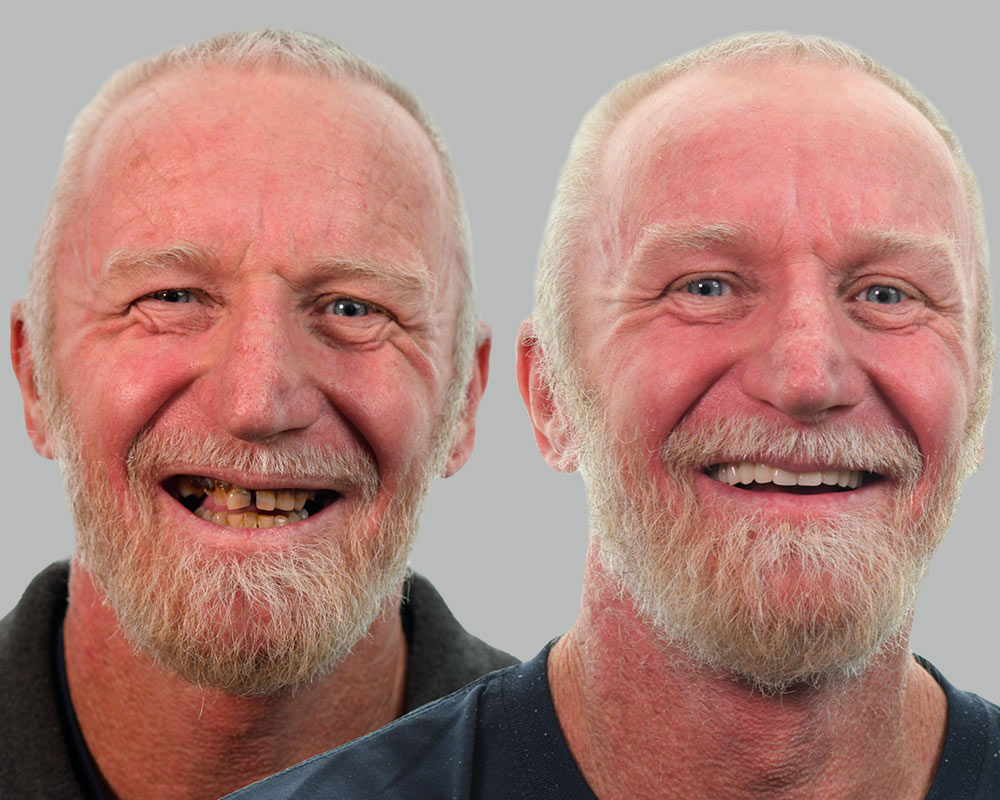 Colin-All-On-4-Before and After