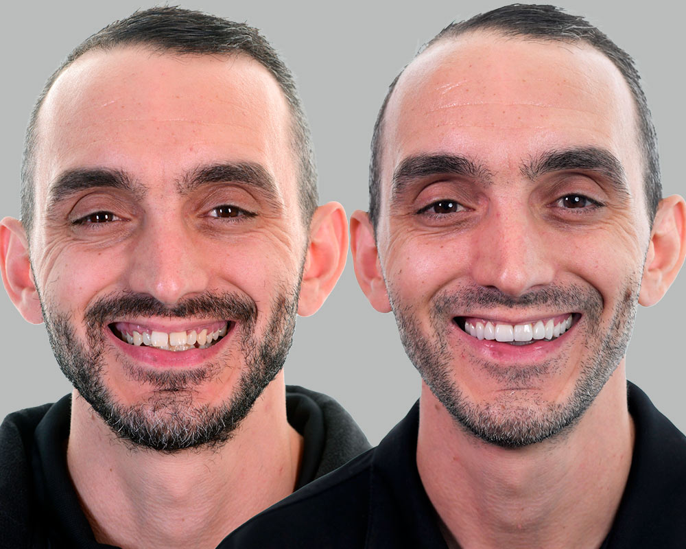 Ben-SmileMakeover-Before and After