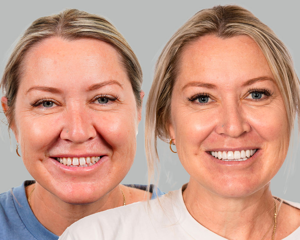 Brodie-SmileMakeover-Before and After