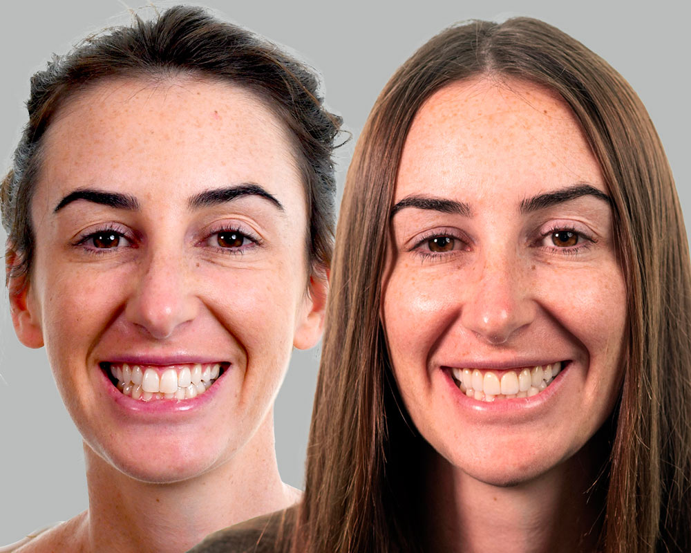Jordan-SmileMakeover-Before and After