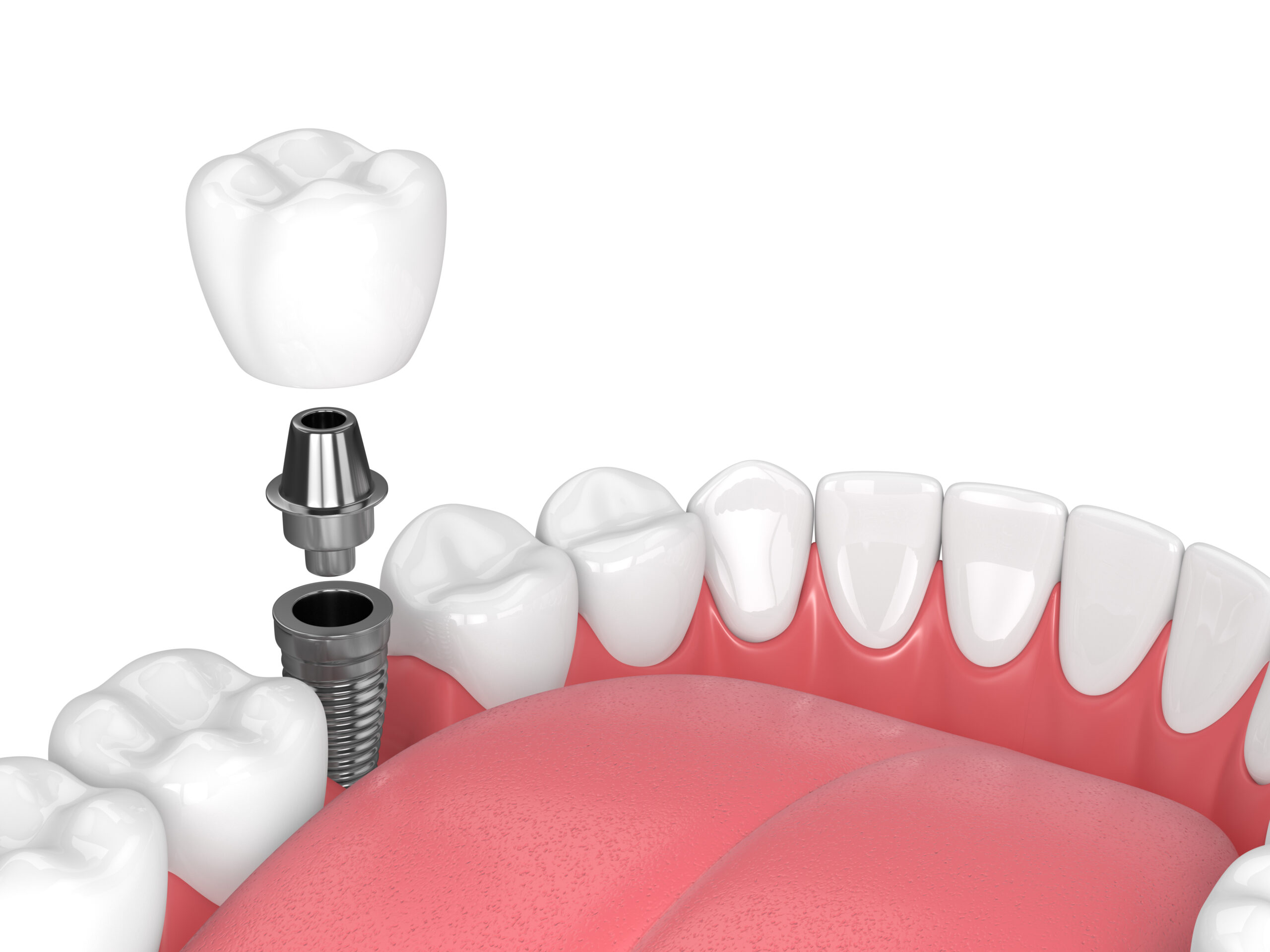Dental implants 