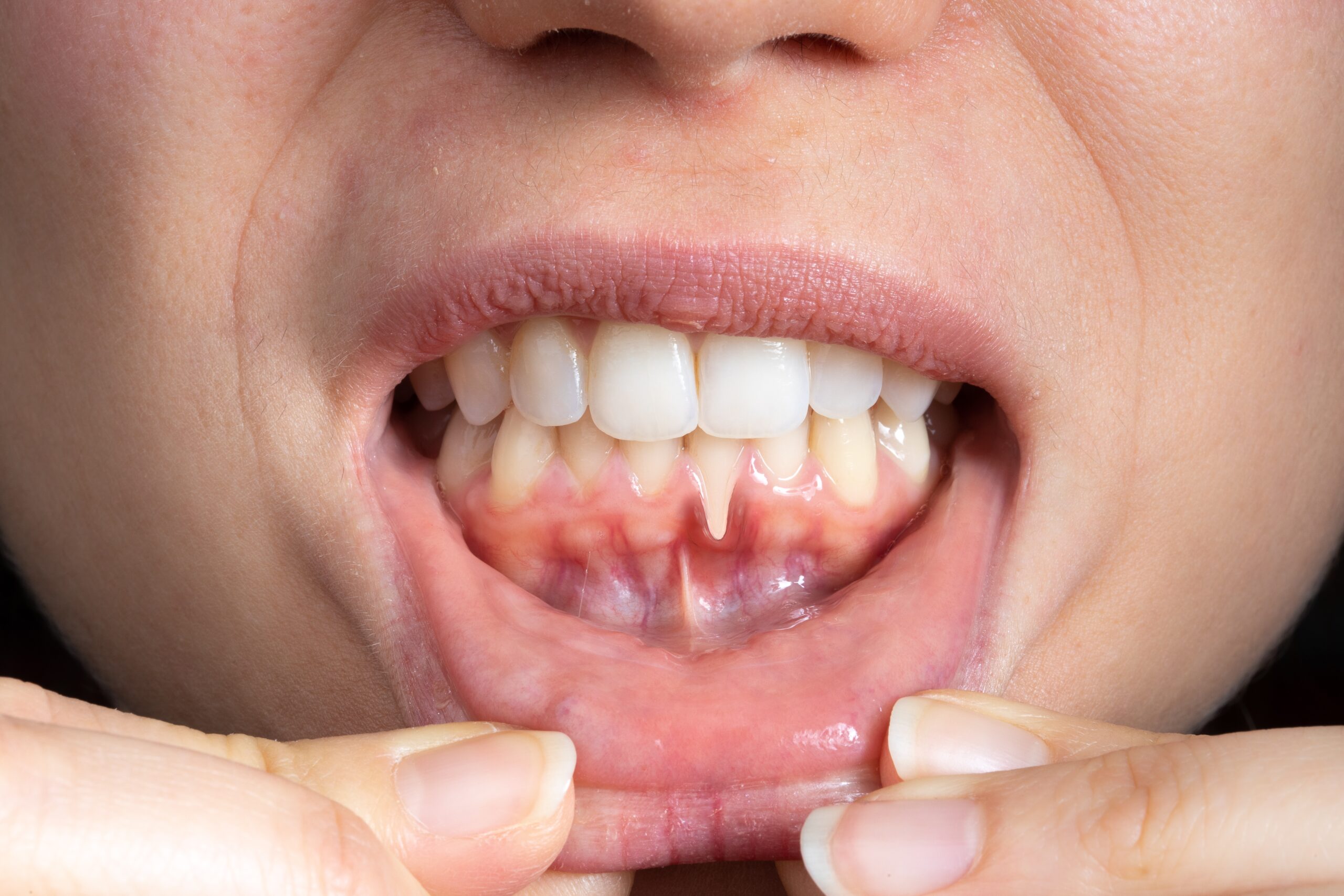 How to fix receding gums