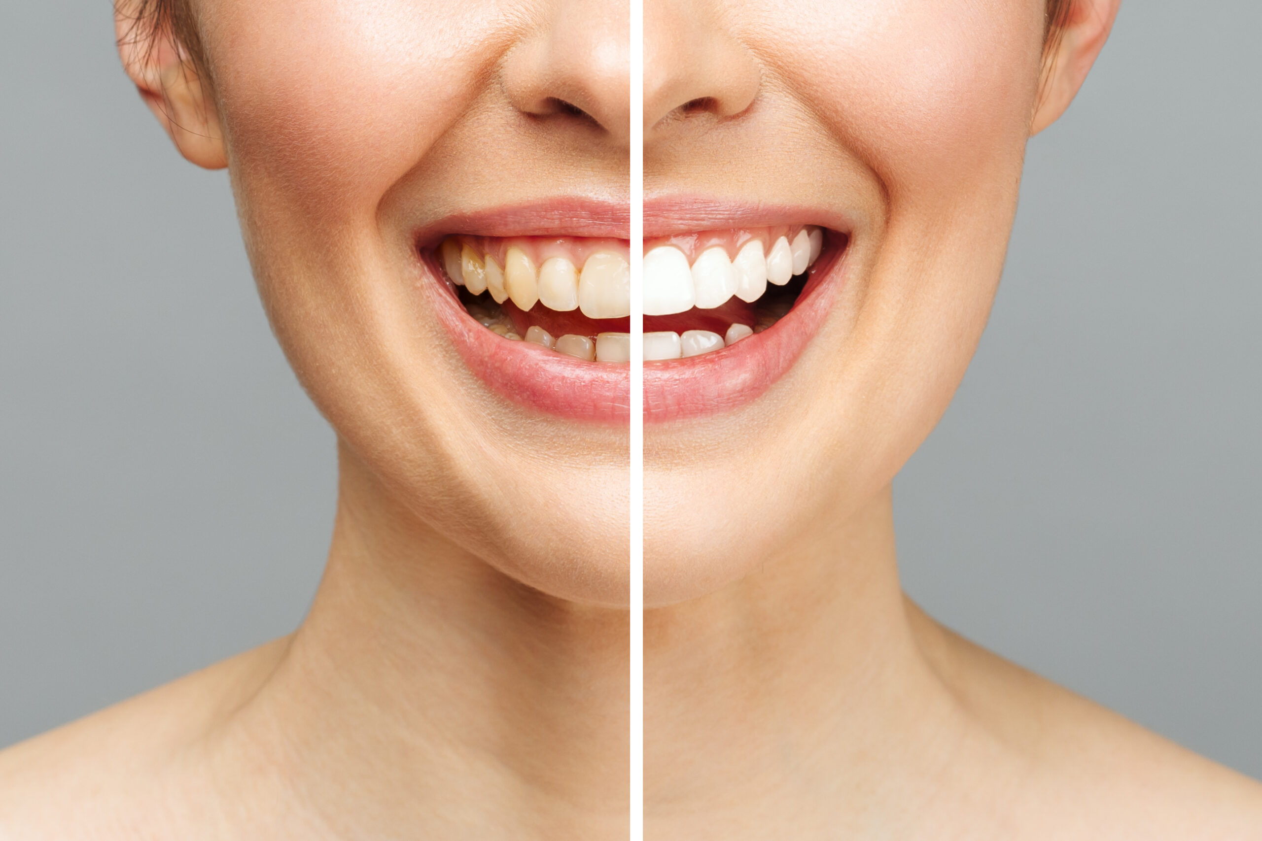Teeth Whitening vs Veneers
