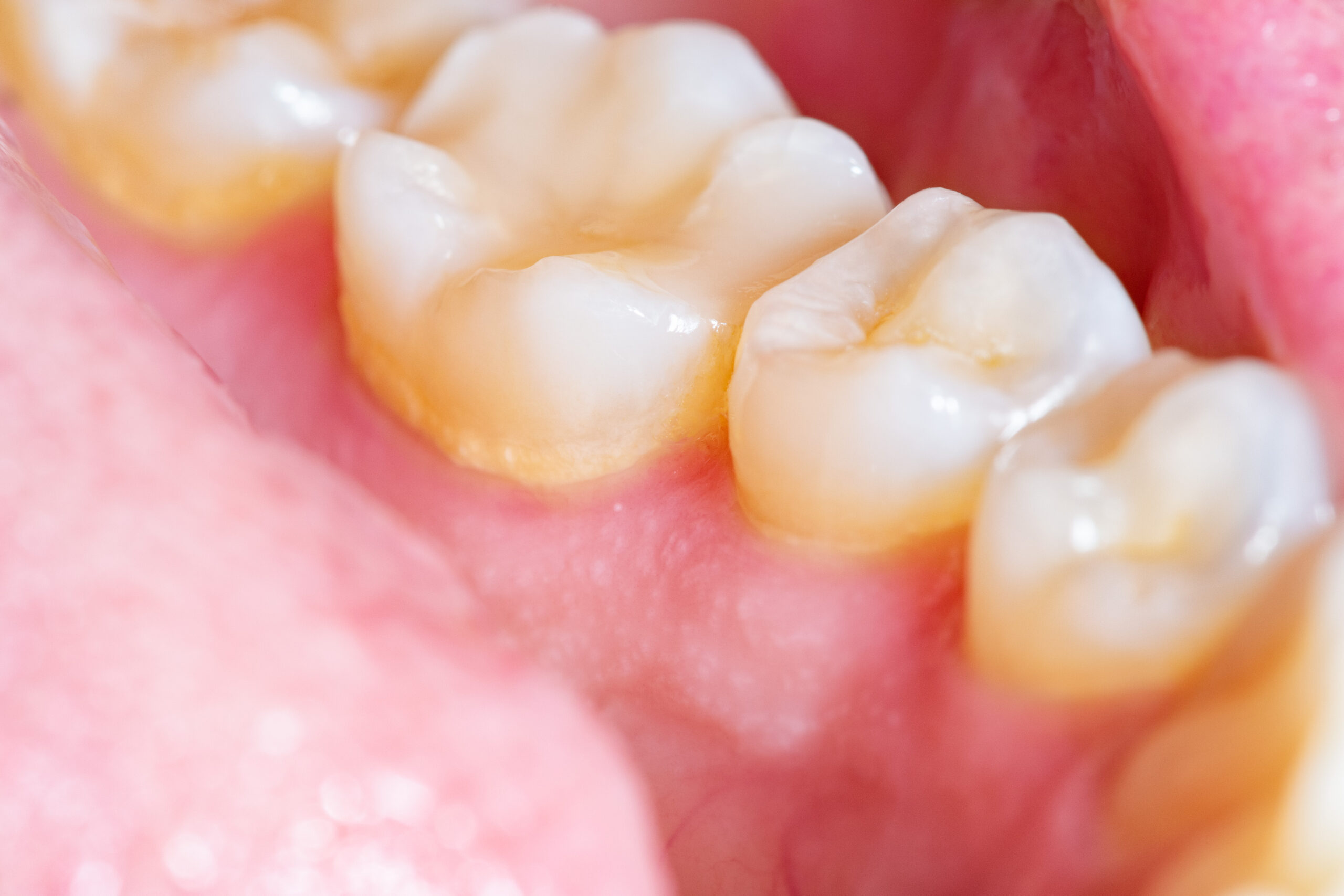 Poor oral health causes