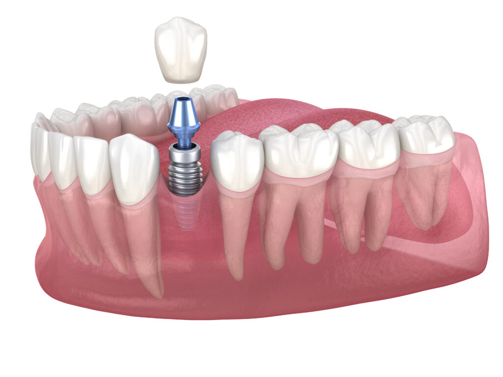 What are dental implants