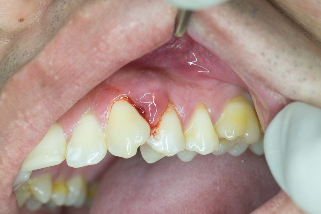 Can you get All-On-4 dental implants with gum disease