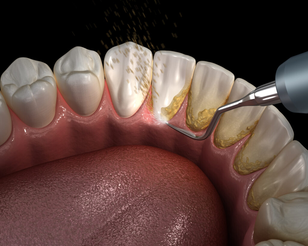 Treatment planning and preparatory steps for All-on-4 implants