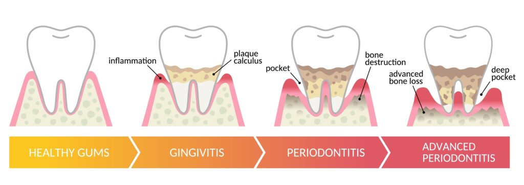 Understanding gum disease 