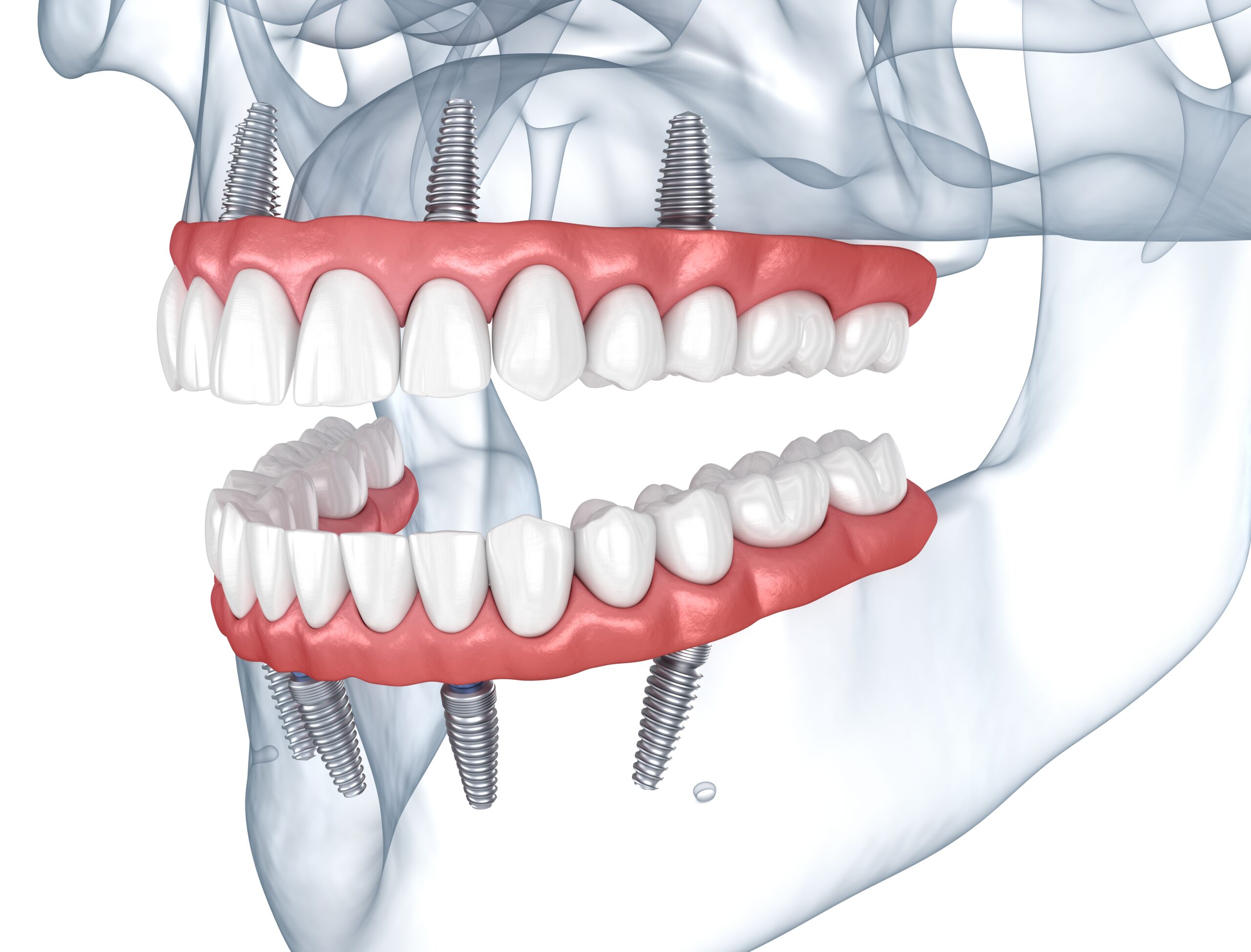 What are All On 4 dental implants