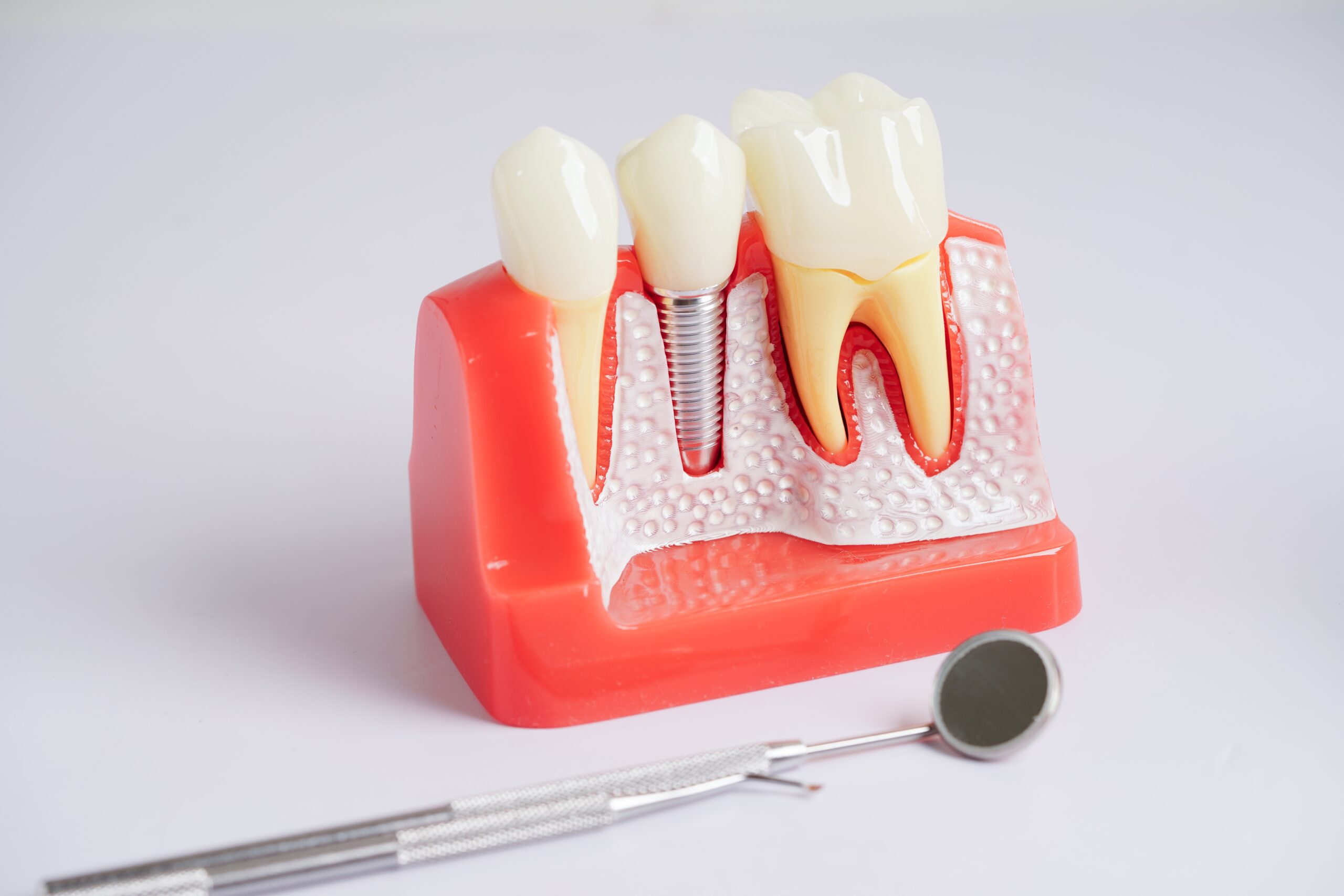 Can Anyone Get Dental Implants Understanding your options