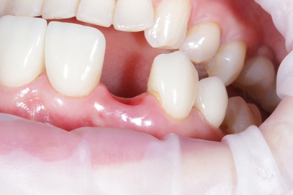 dental implants in full mouth reconstruction