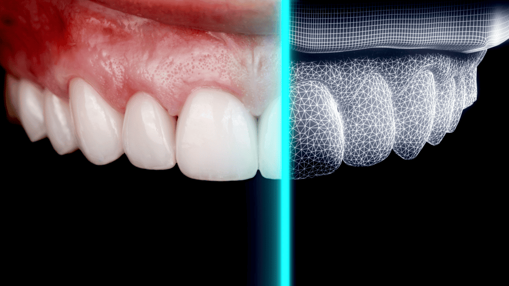 Custom-made porcelain veneers, crafted from ultra-thin porcelain, are seamlessly bonded to your teeth to mimic the natural characteristics of your smile