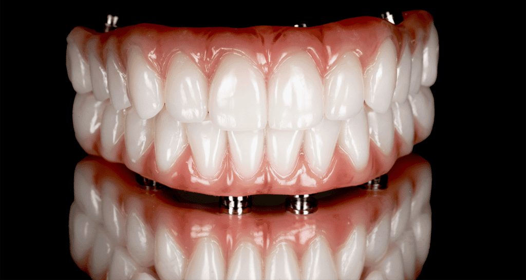 All on four dental implants service