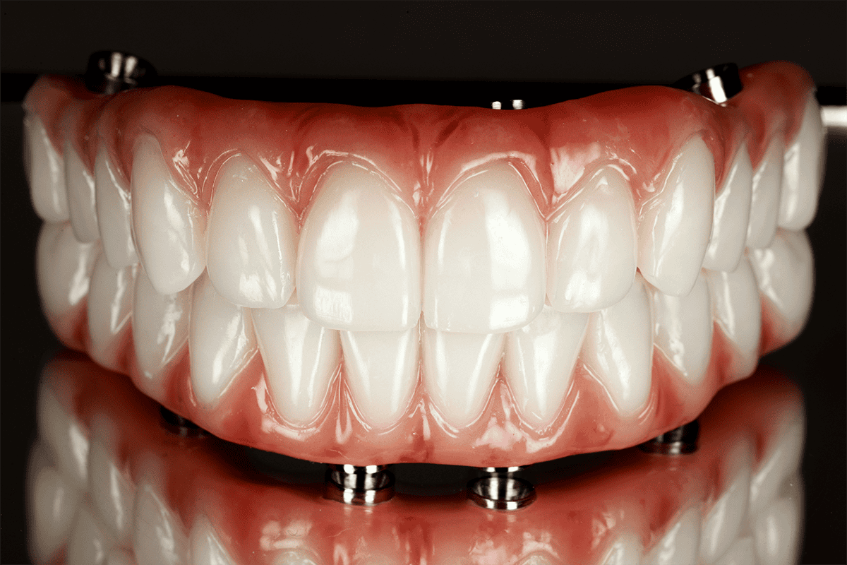 All-on-4 for severely worn or missing teeth