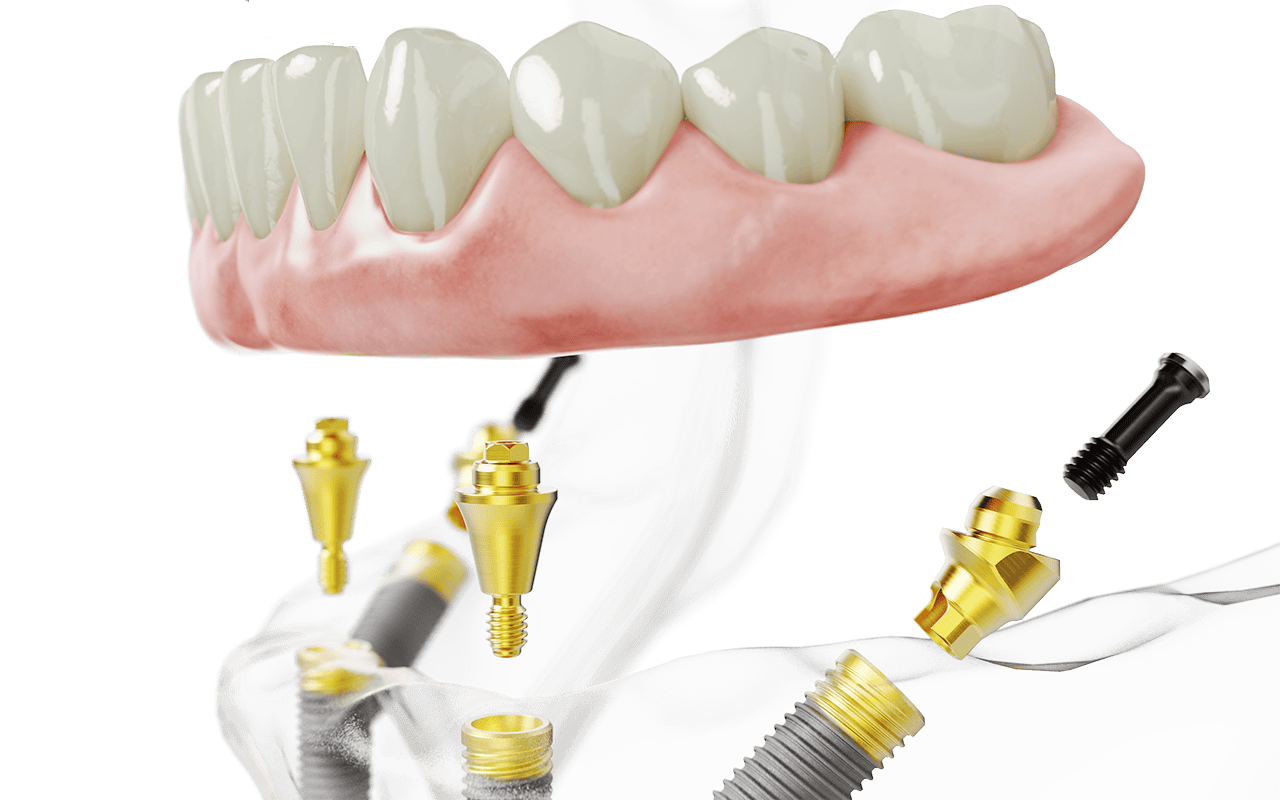 All-on-4 dental restoration showing a full arch of upper or lower teeth securely supported by four strategically angled titanium implants, offering a fixed, long-term alternative to removable dentures.