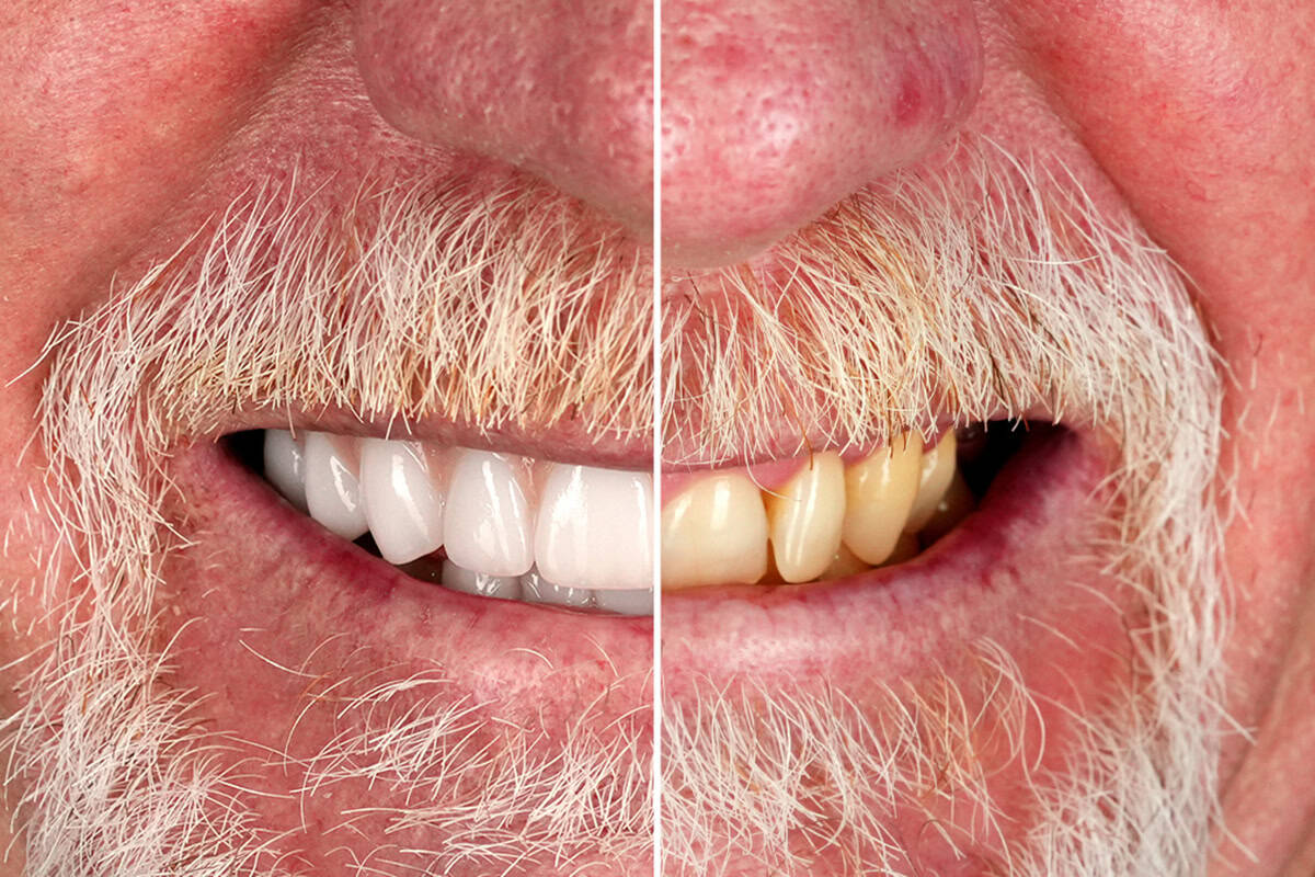 Tooth decay and advancing gum disease emphasizing early dental care.