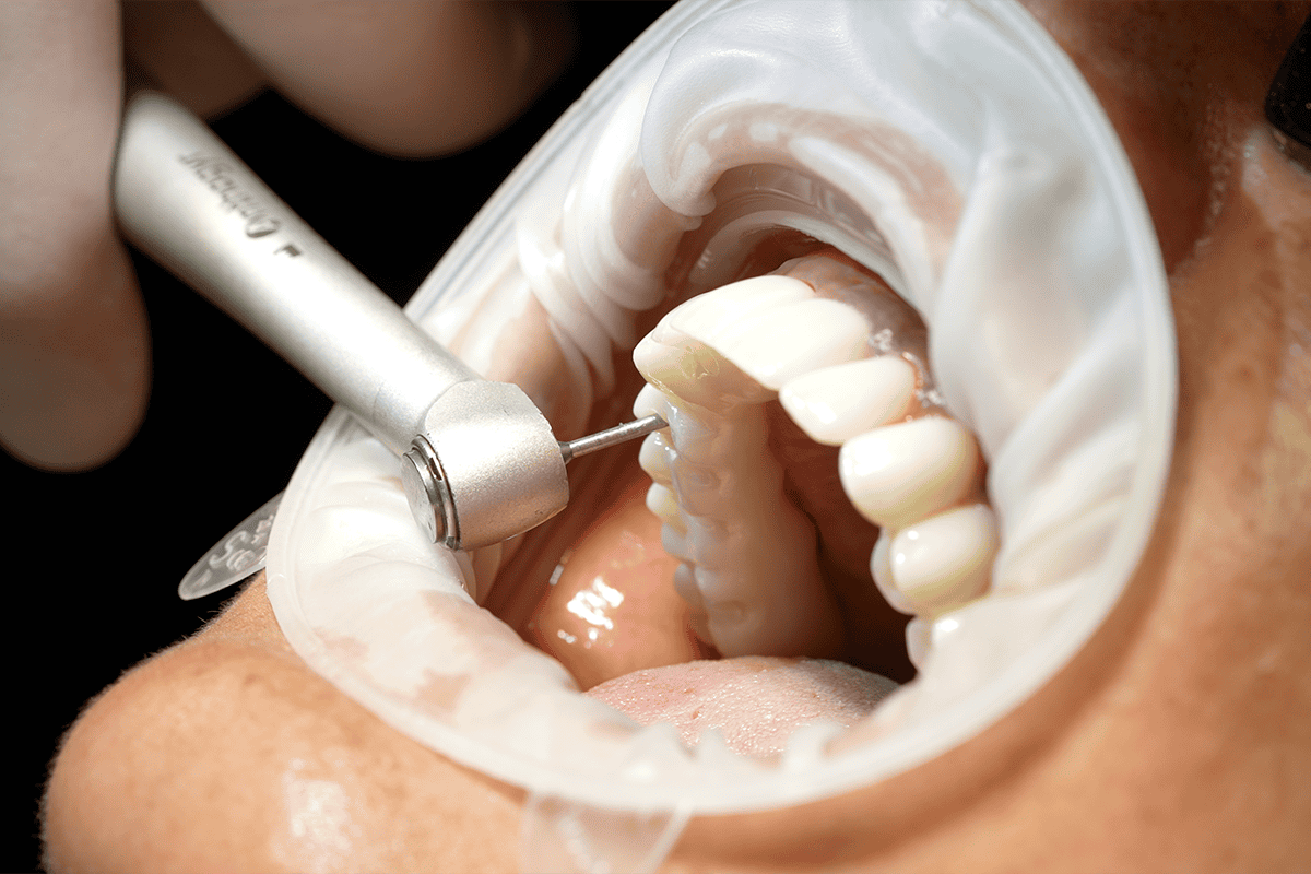Ongoing maintenance of porcelain veneers, requires daily brushing, flossing and regular professional cleans