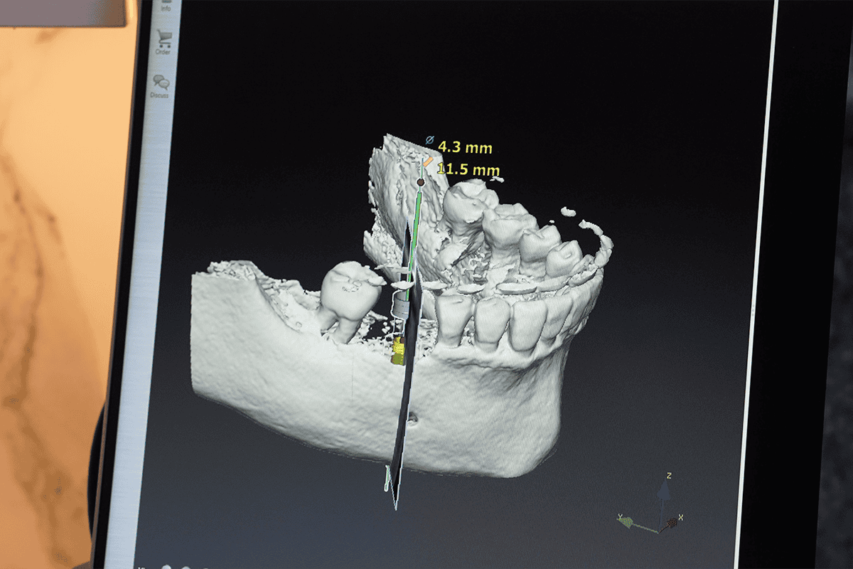 A dental implant procedure showing a titanium post placed into the jawbone to replace a missing tooth, topped with a custom crown