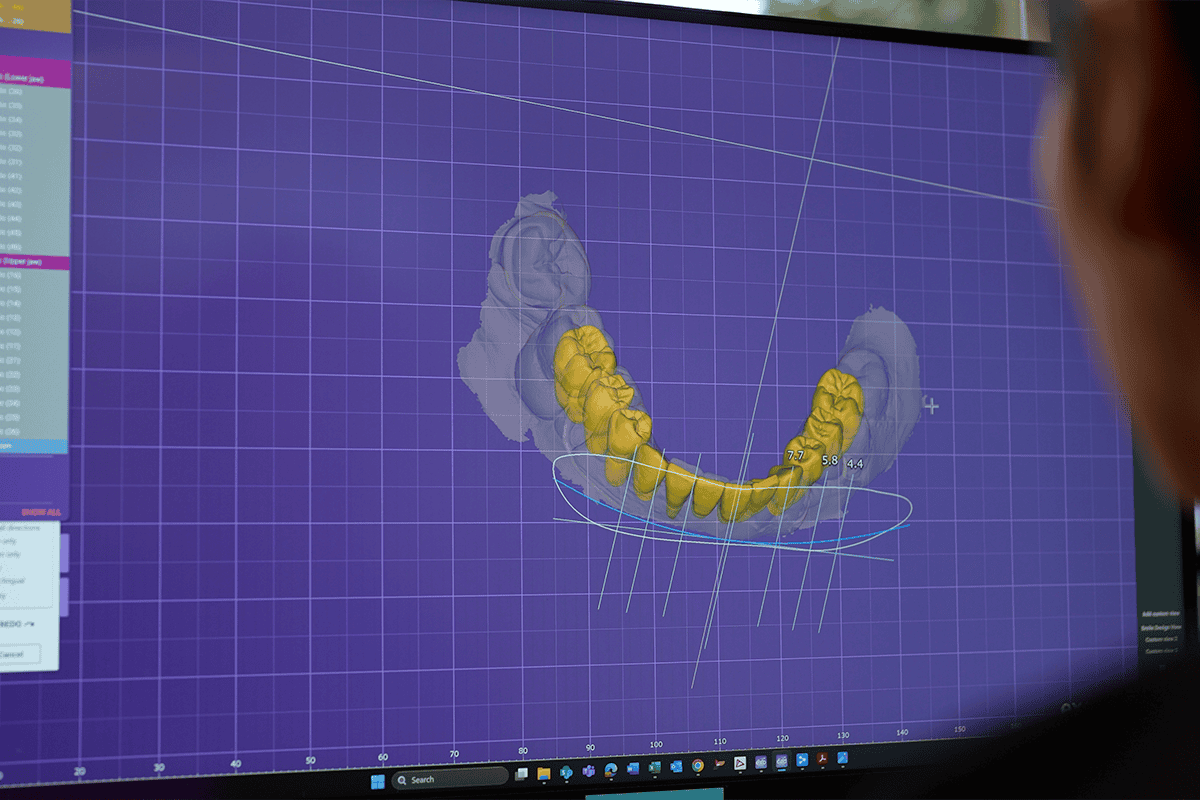 Dental fixes that lead to repeated treatments and higher long-term costs versus comprehensive solutions like porcelain veneers or full mouth reconstruction