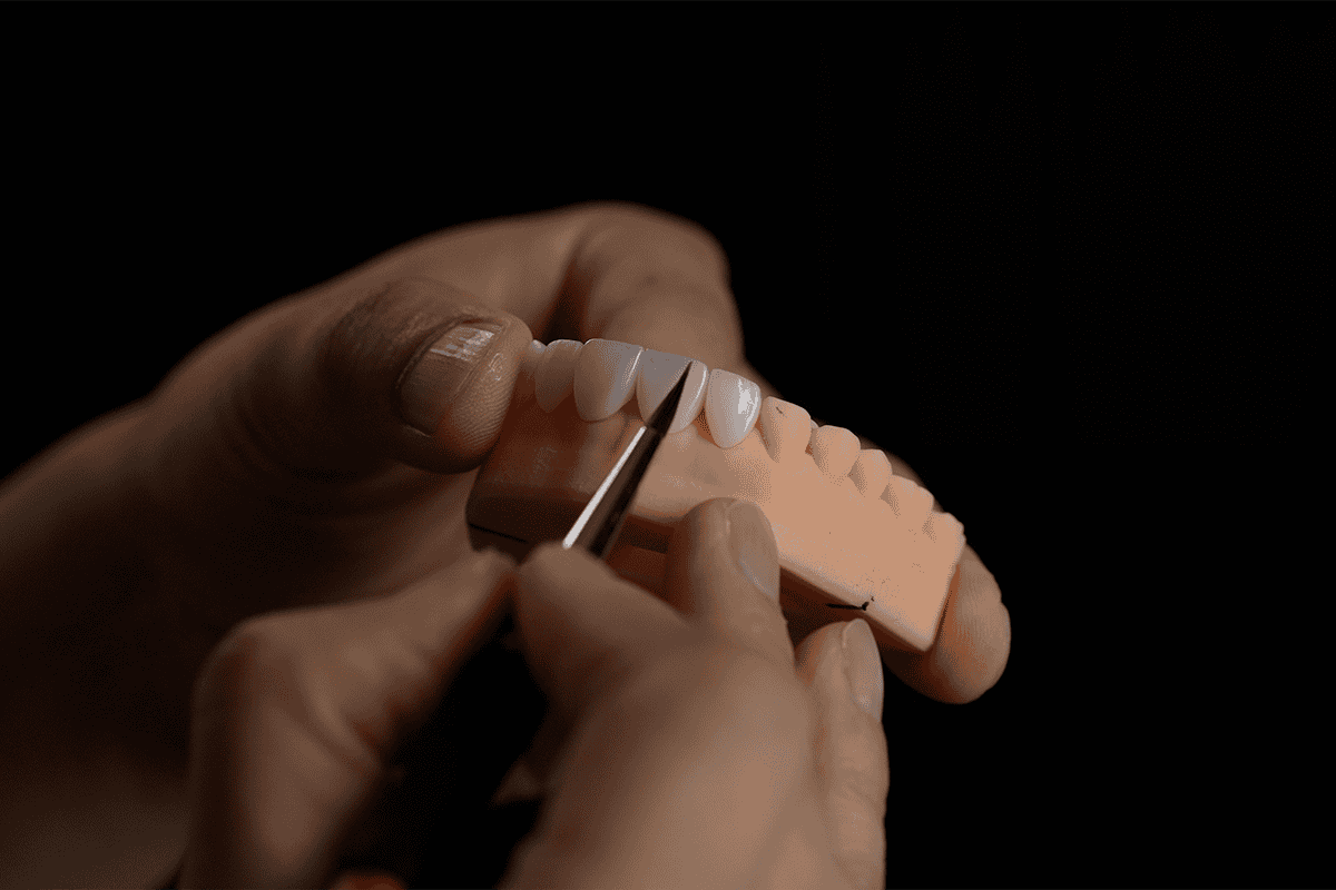 Veneers and dental implants treatment for receding gums