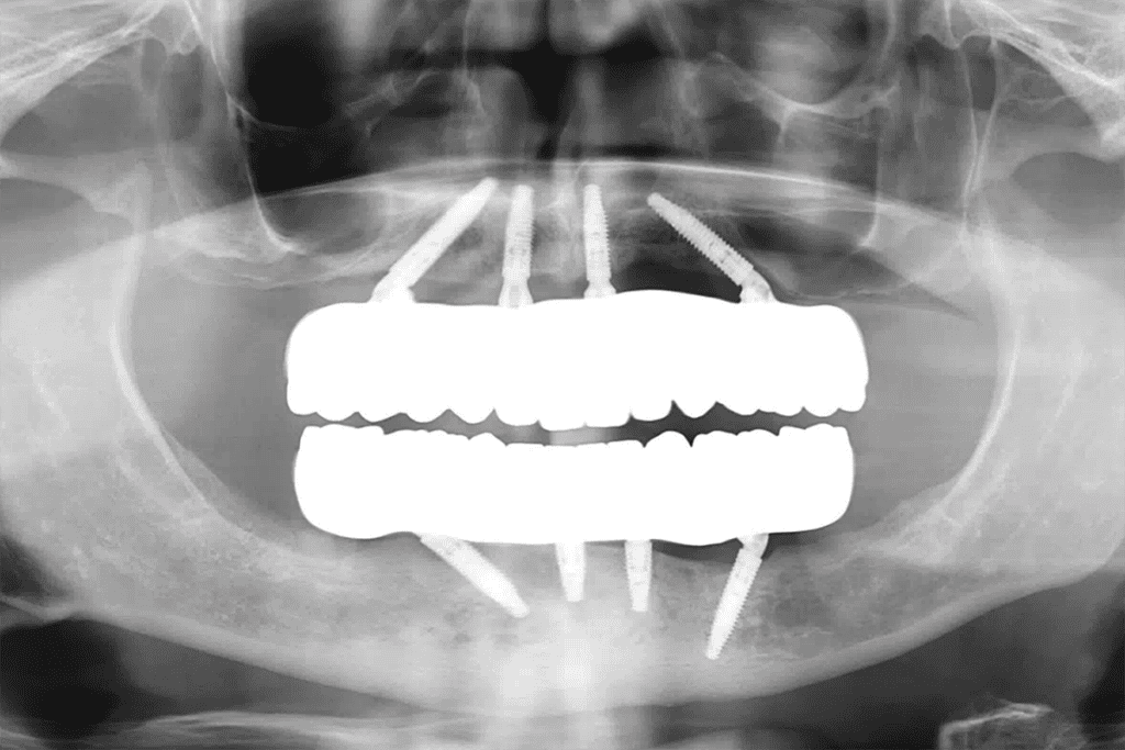 What Is All-On-4 dental implants xray