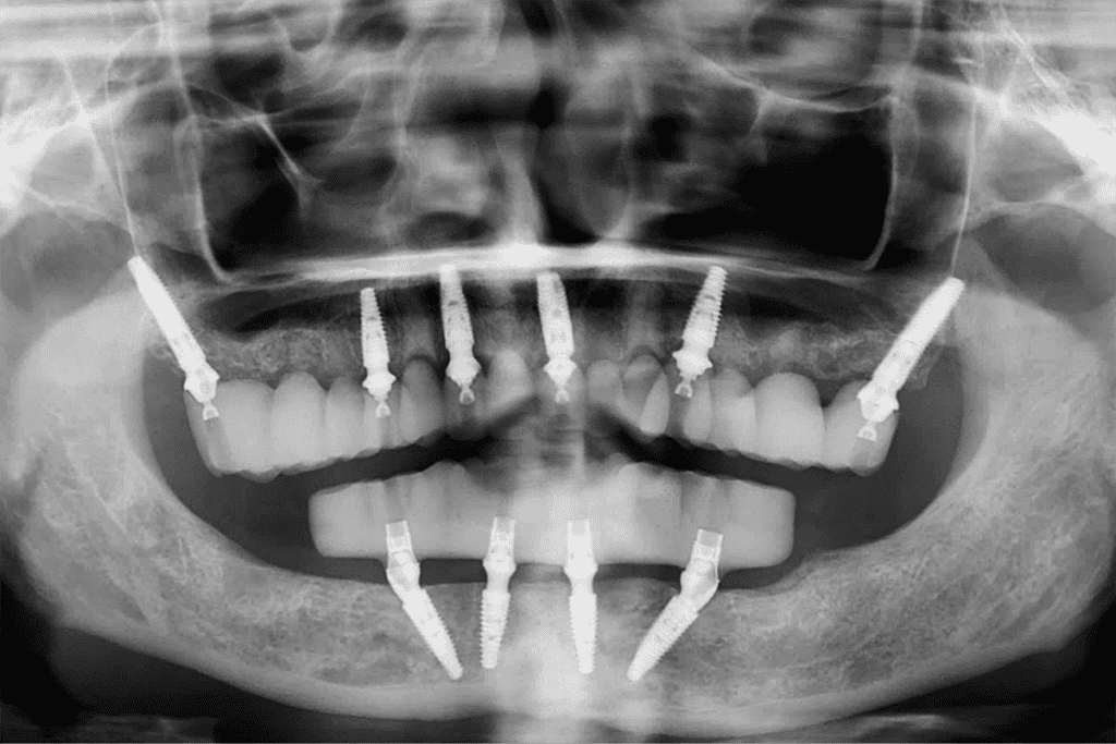 The Clinical Case for Additional Implants in FP1 Treatment