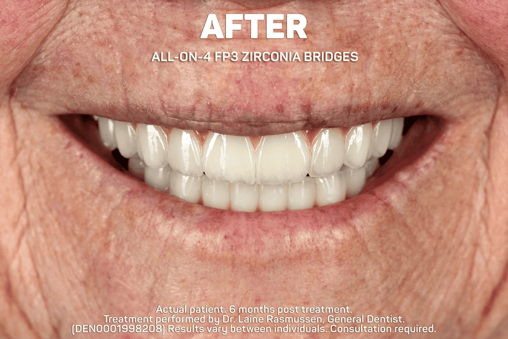 All-on-4 treatment after