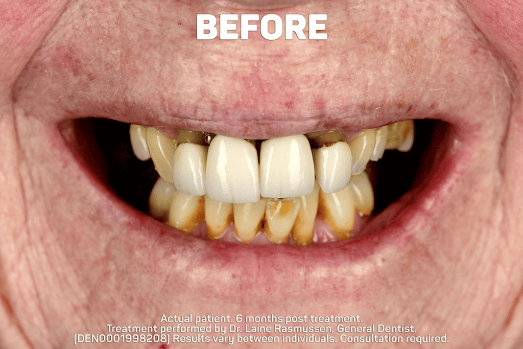 Full Arch Implant Treatment Before