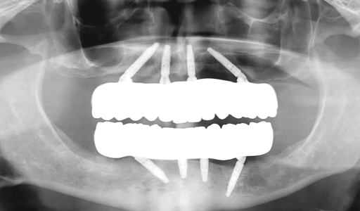 AO4_Zirconia