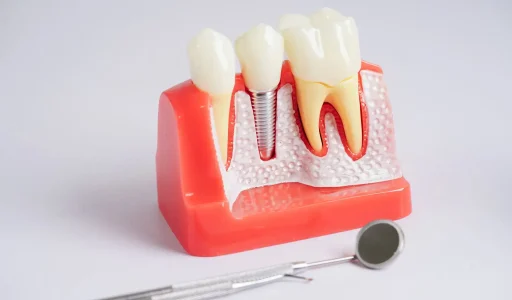 Can-Anyone-Get-Dental-Implants-Understanding-your-options-2048x1365