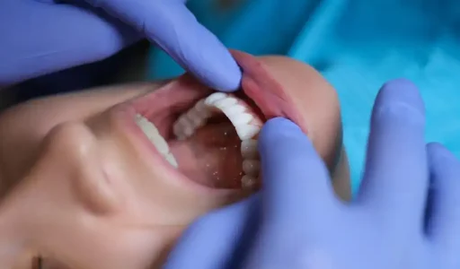 Can-Veneers-Look-Natural-1024x675