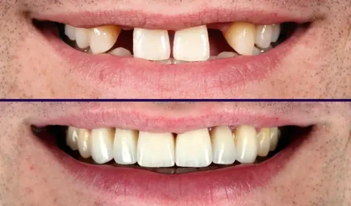 MissingTeethVeneers