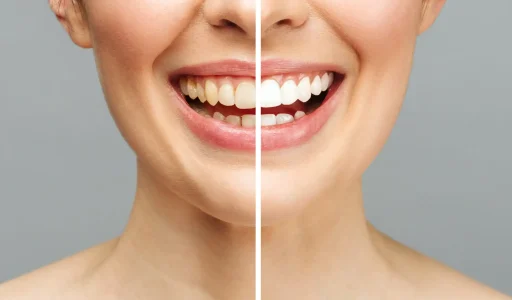 Teeth-Whitening-vs-Veneers-2048x1365