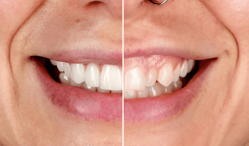 The Porcelain Veneers Process: What to Expect