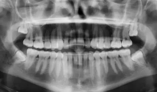 teethxraywisdom